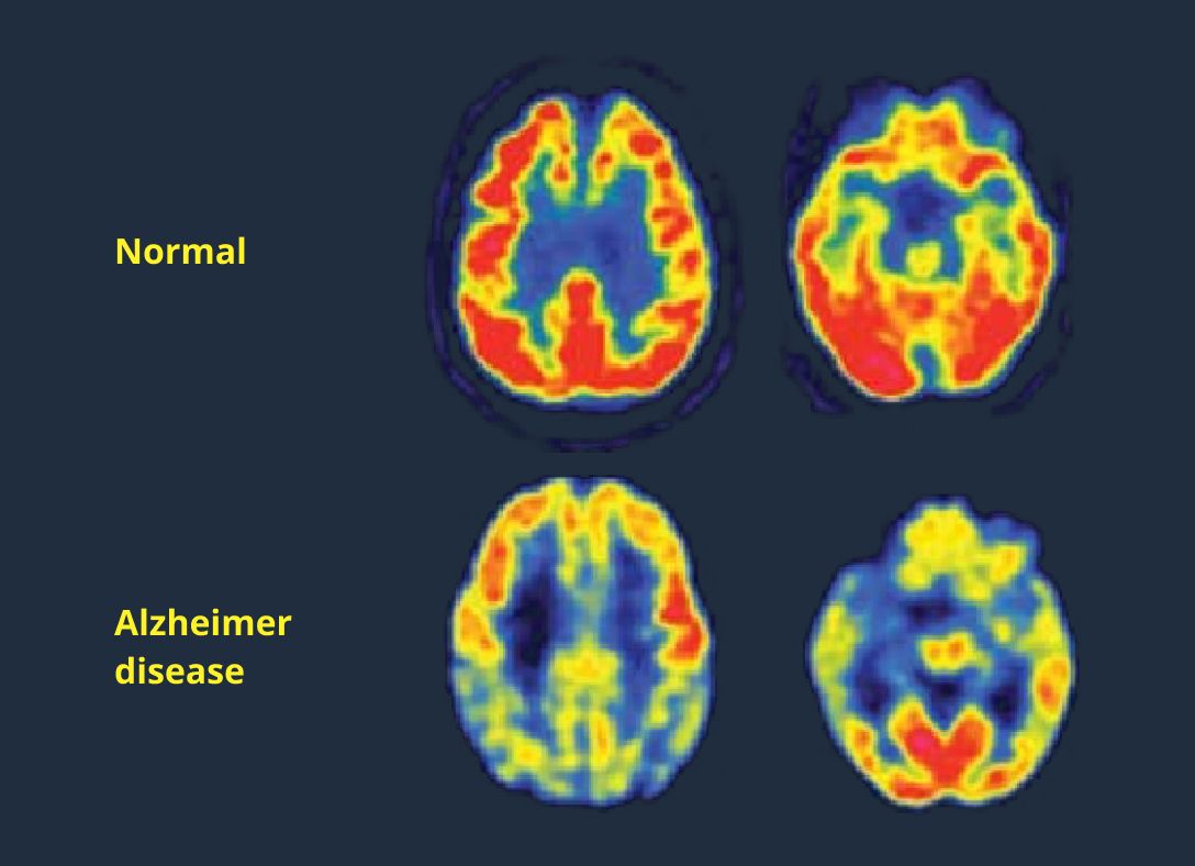 Erkennung der Alzheimer-Krankheit